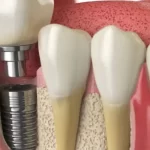 Tips To Choose The Right Dental Implant for You