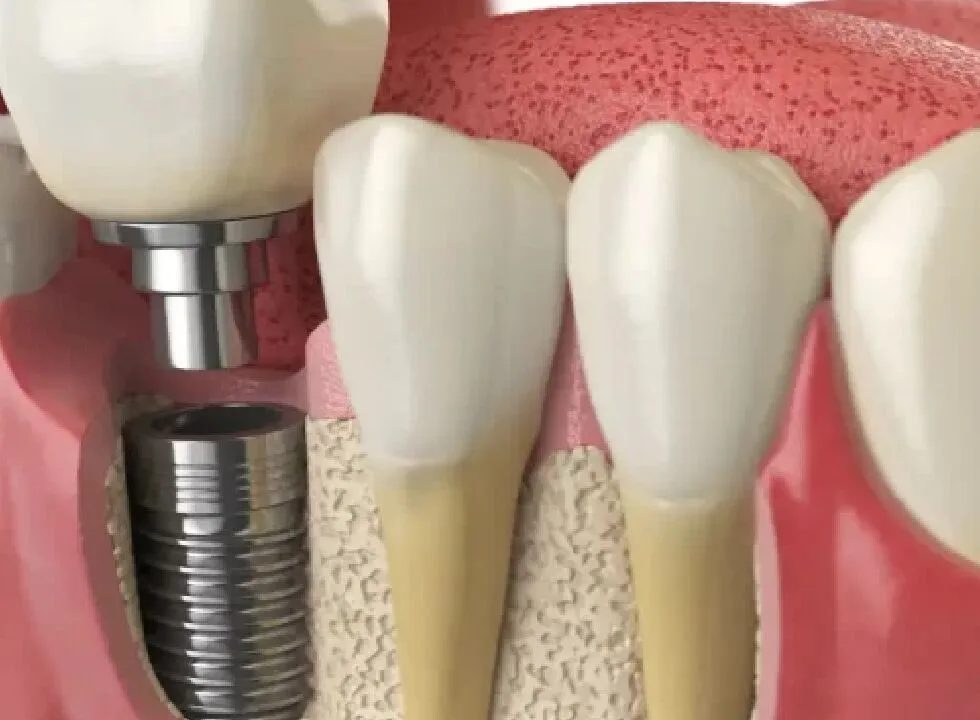 Tips To Choose The Right Dental Implant for You